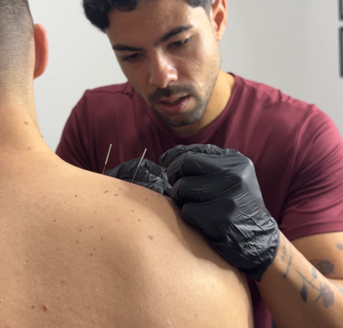 Técnica de Dry Needling